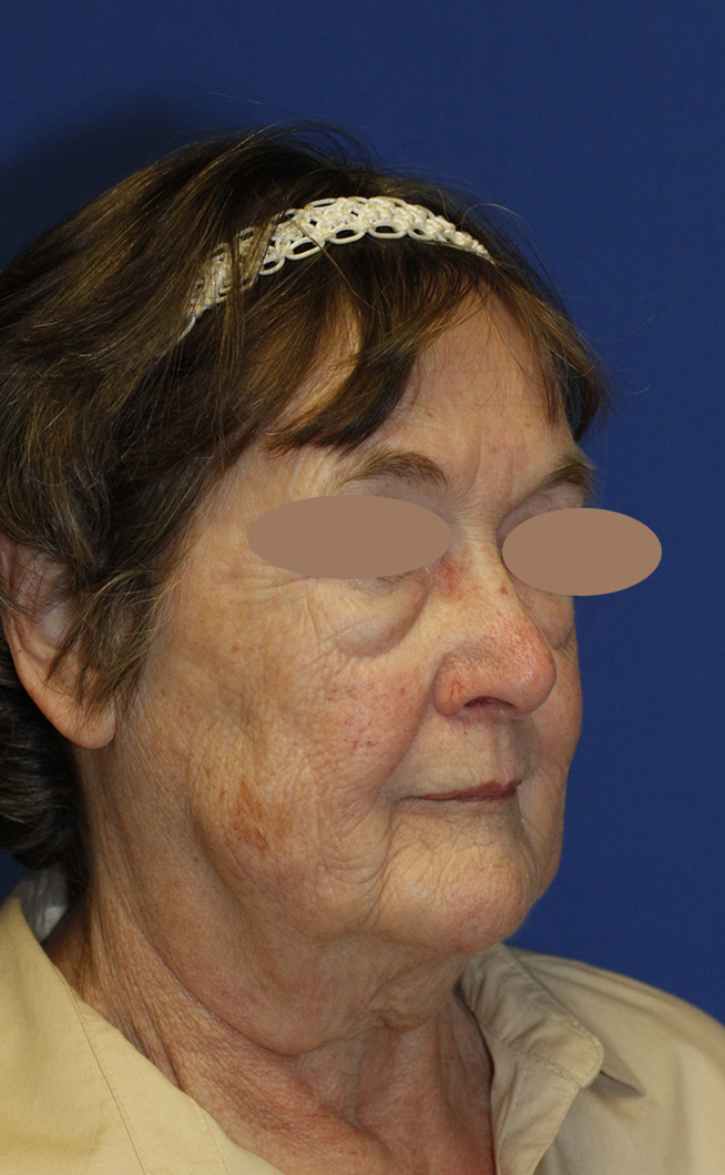 Lower Blepharoplasty Before R Oblique