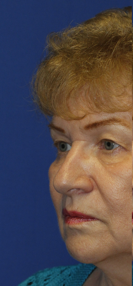 Blepharoplasty Before L Oblique