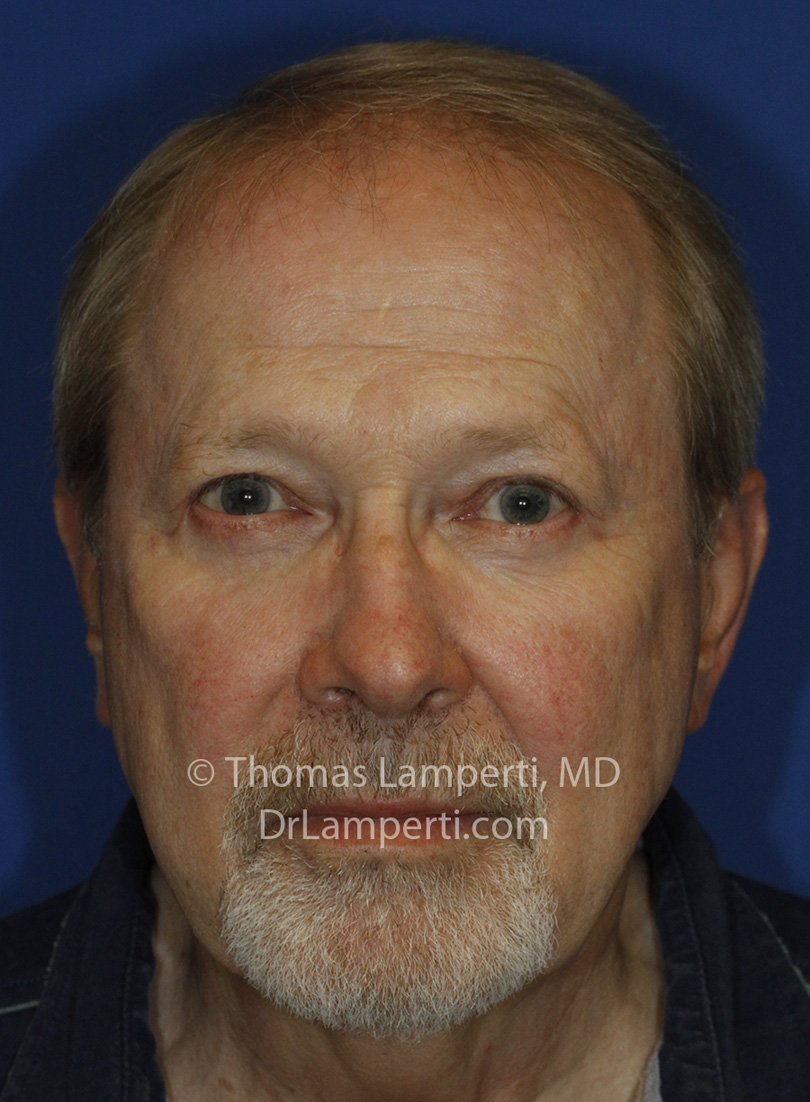 Blepharoplasty After Frontal