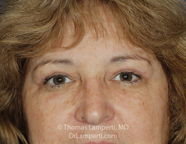 Blepharoplasty Frontal After