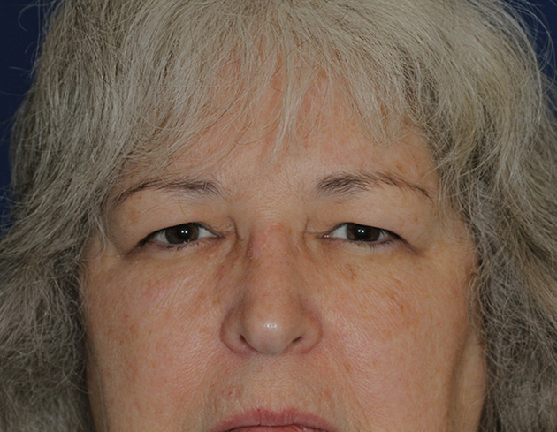 Blepharoplasty Frontal Before