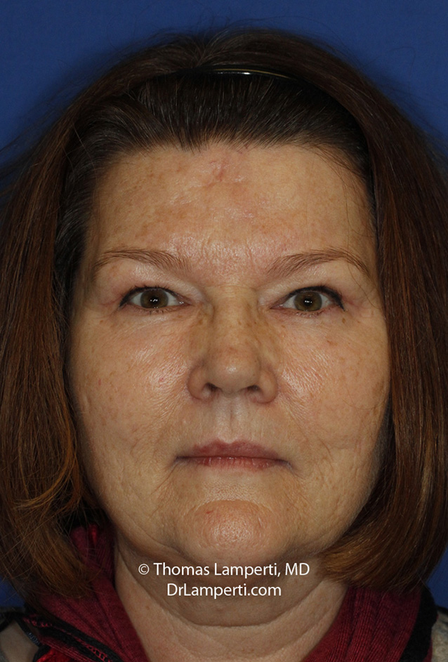 Blepharoplasty After Frontal