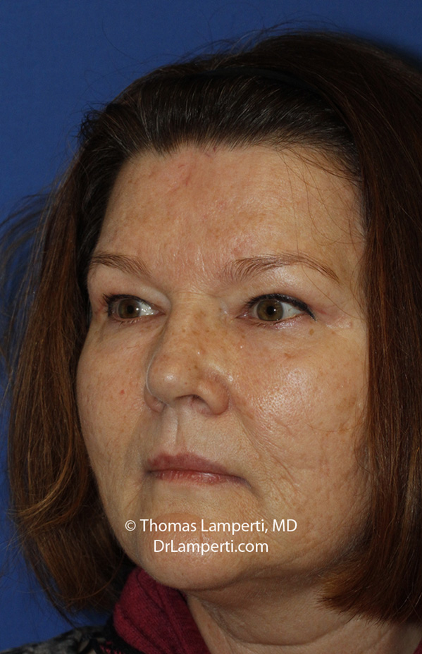 Blepharoplasty After L Oblique