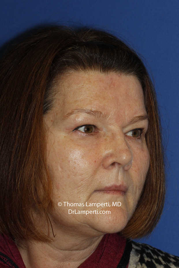 Blepharoplasty After R Oblique