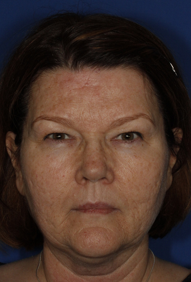 Blepharoplasty Before Frontal