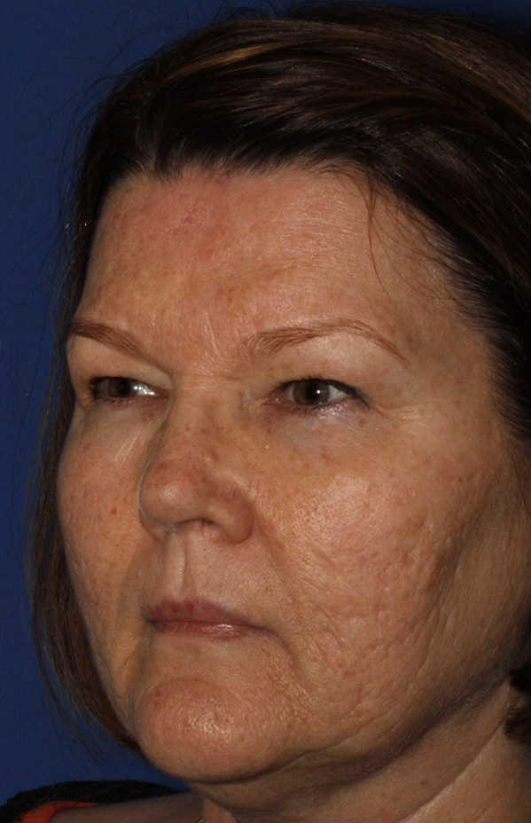 Blepharoplasty Before L Oblique