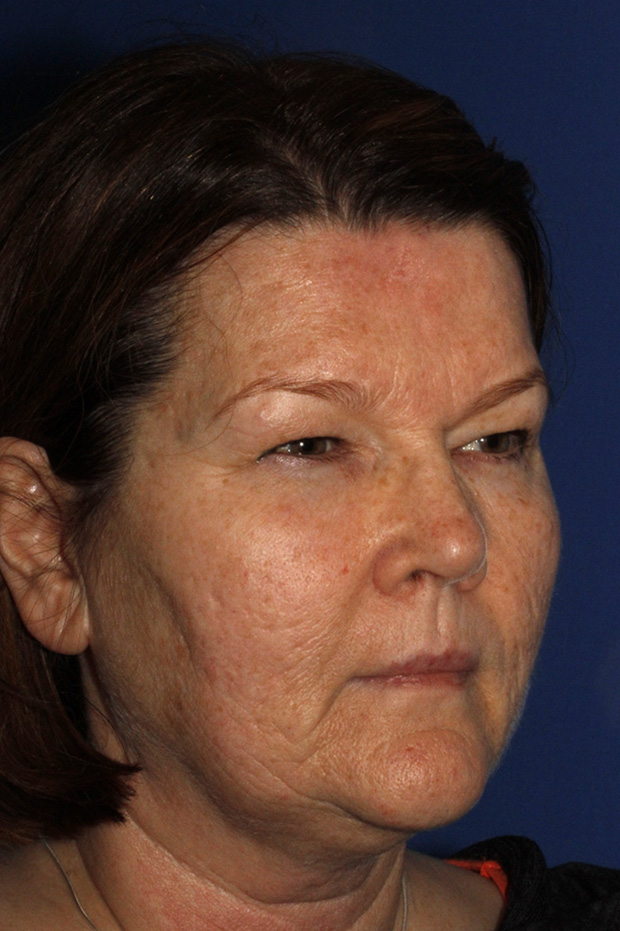 Blepharoplasty Before R Oblique