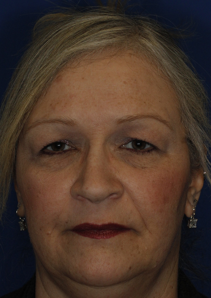 Blepharoplasty Frontal Before