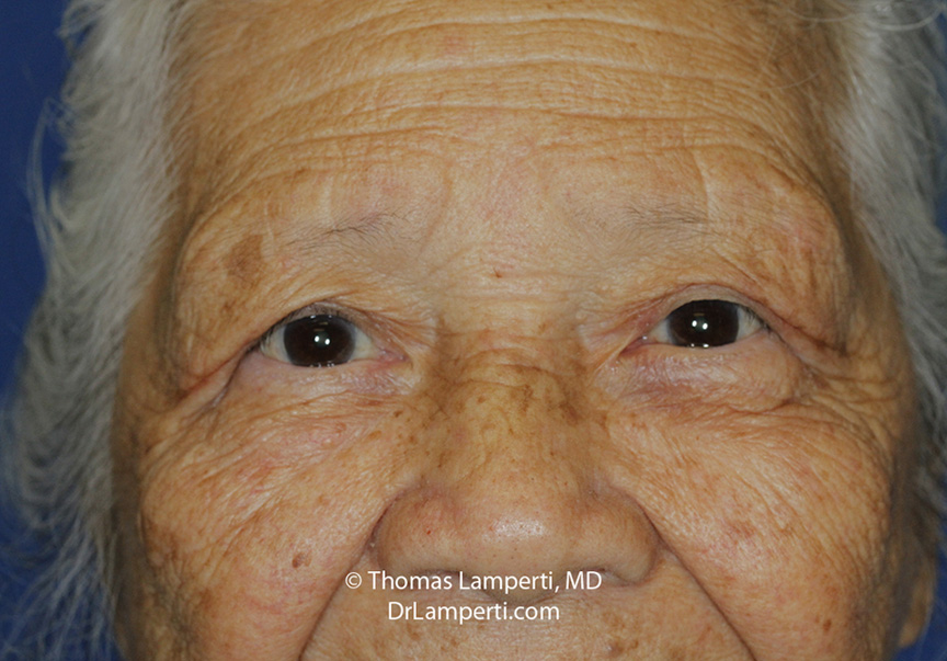 Blepharoplasty After Frontal