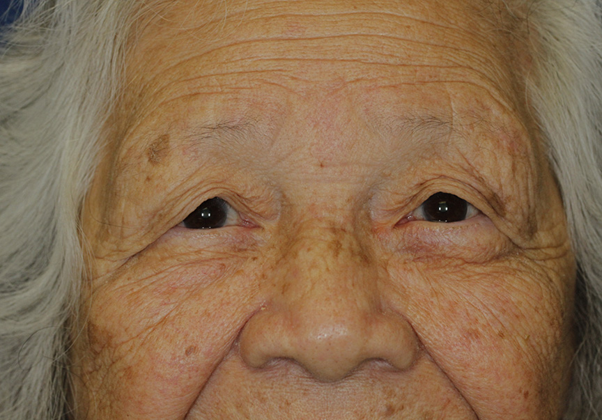 Blepharoplasty Before Frontal