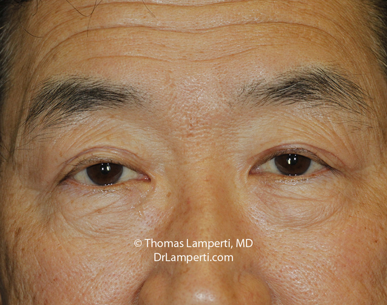 Blepharoplasty Ptosis Repair After