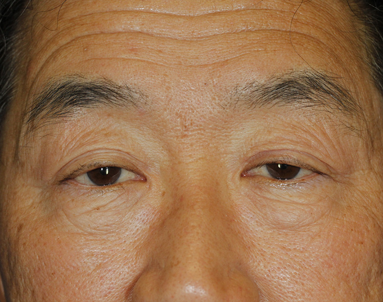 Blepharoplasty Ptosis Repair Before