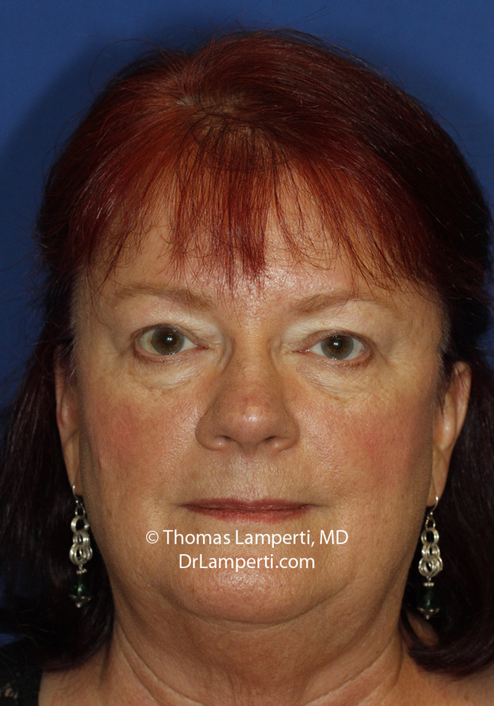 Blepharoplasty After Frontal