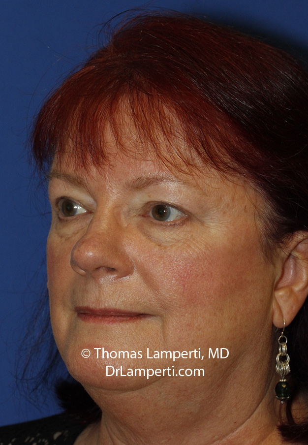 Blepharoplasty After L Oblique