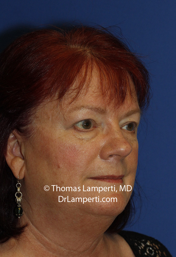 Blepharoplasty After R Oblique