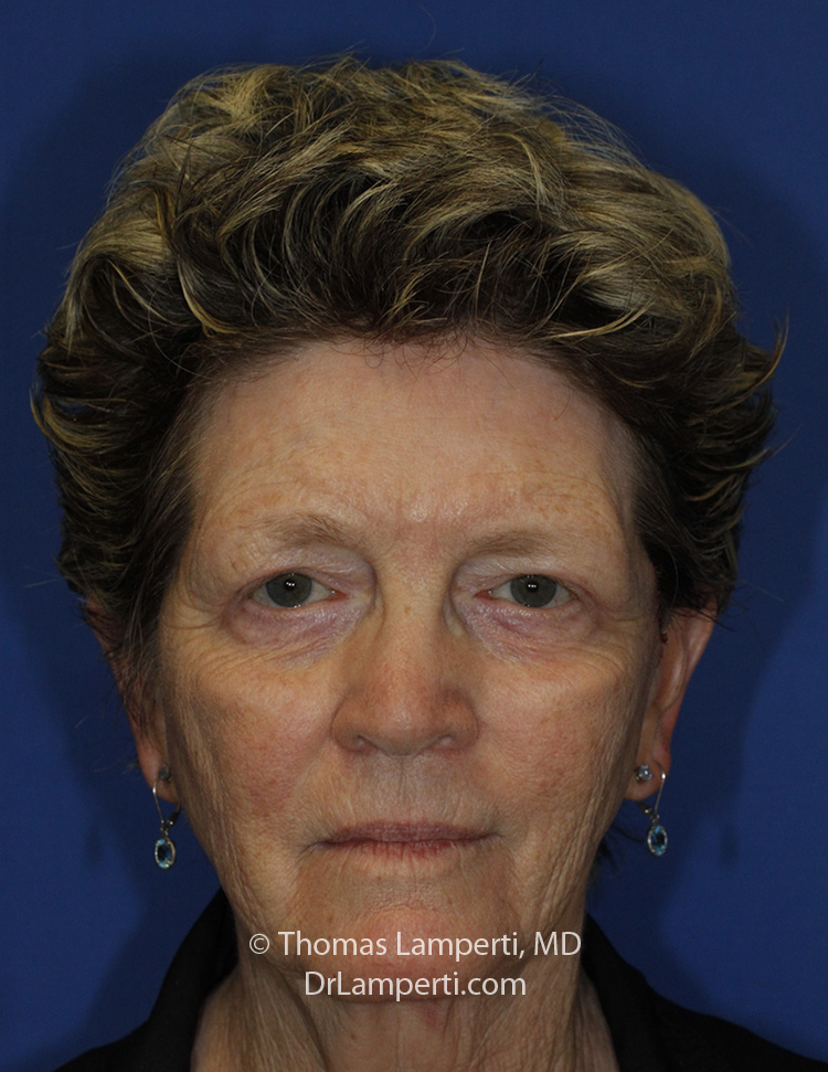 Blepharoplasty Frontal After