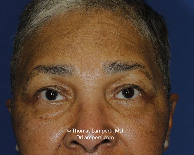 Blepharoplasty After Frontal