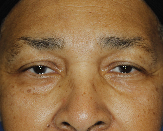 Blepharoplasty Before Frontal