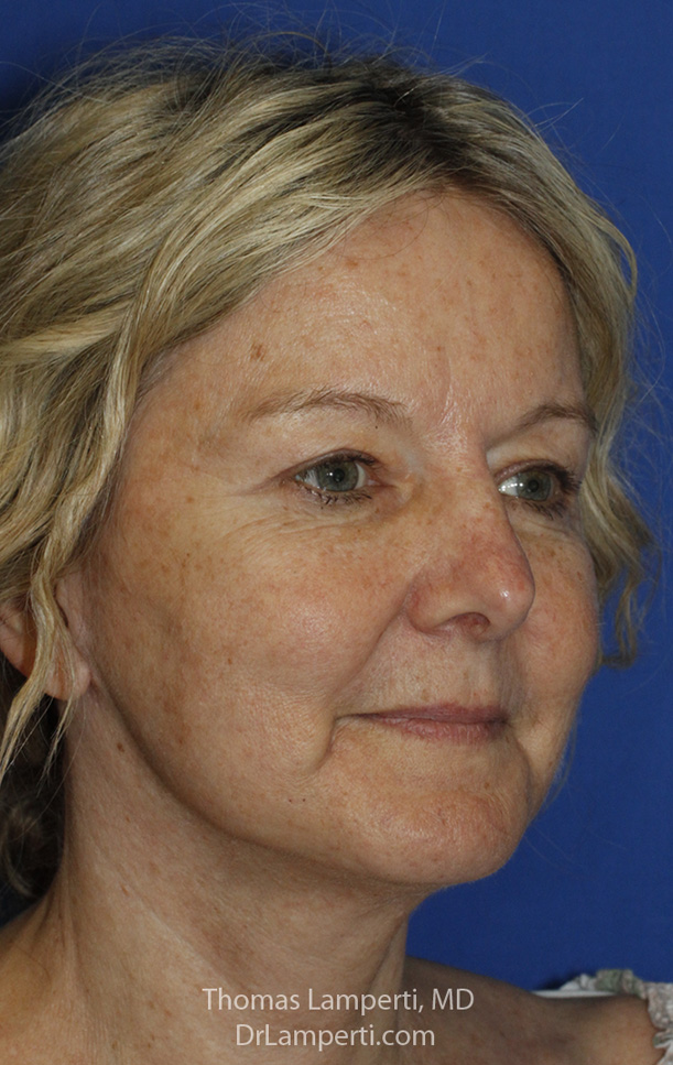 Blepharoplasty After R Oblique