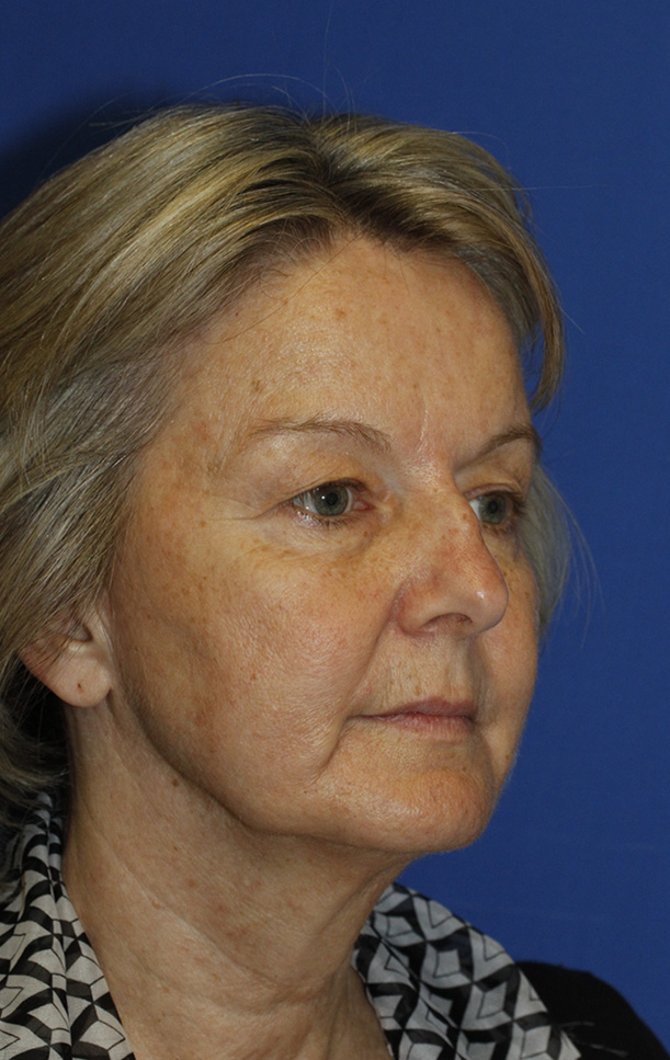 Blepharoplasty Before R Oblique