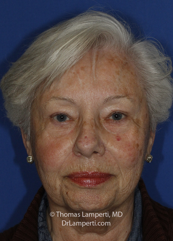 After Blepharoplasty