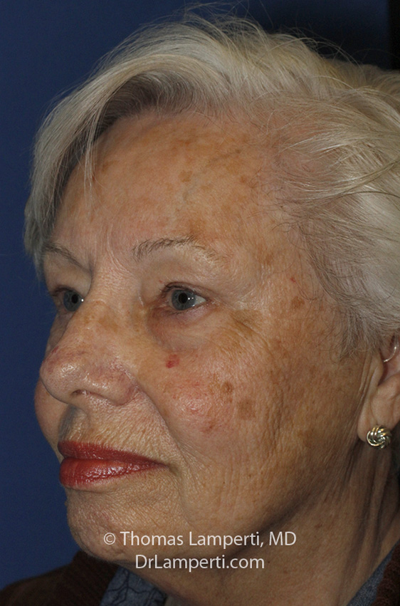 Blepharoplasty After L Oblique