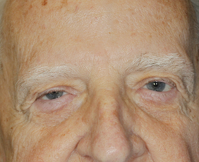 Blepharoplasty and Ptosis Repair Before