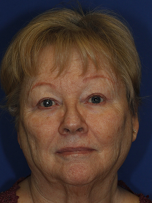 Blepharoplasty After