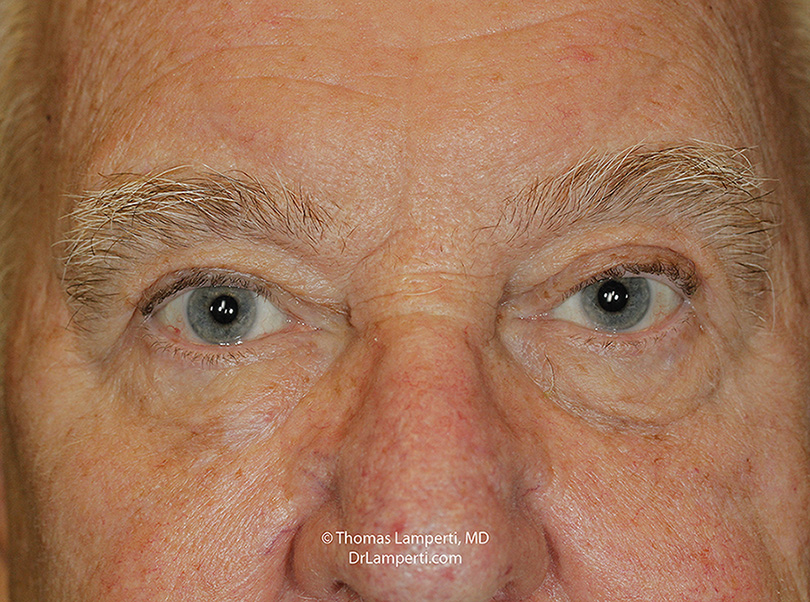 Blepharoplasty Ptosis RepairAfter