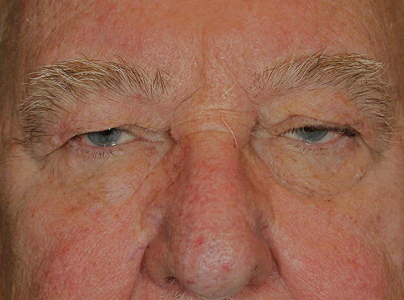 Blepharoplasty Ptosis Repair Before