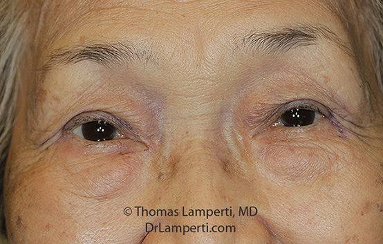 Blepharoplasty After