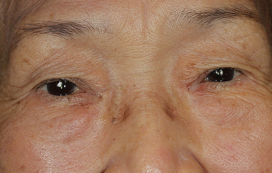 Blepharoplasty Before