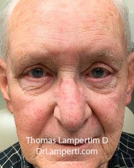 Blepharoplasty After