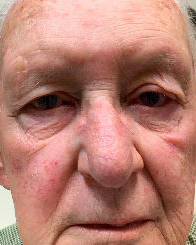 Blepharoplasty Before