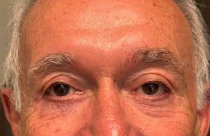 Blepharoplasty after