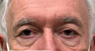 Blepharoplasty before