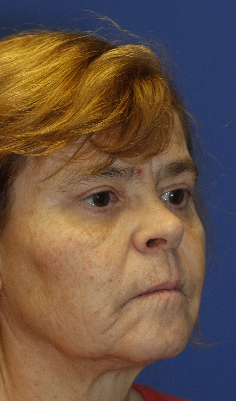 Blepharoplasty after photo