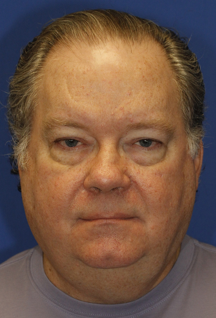 Before Male blepharoplasty Photo