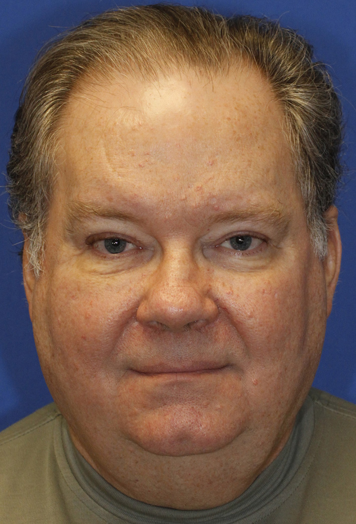 After Male blepharoplasty Photo