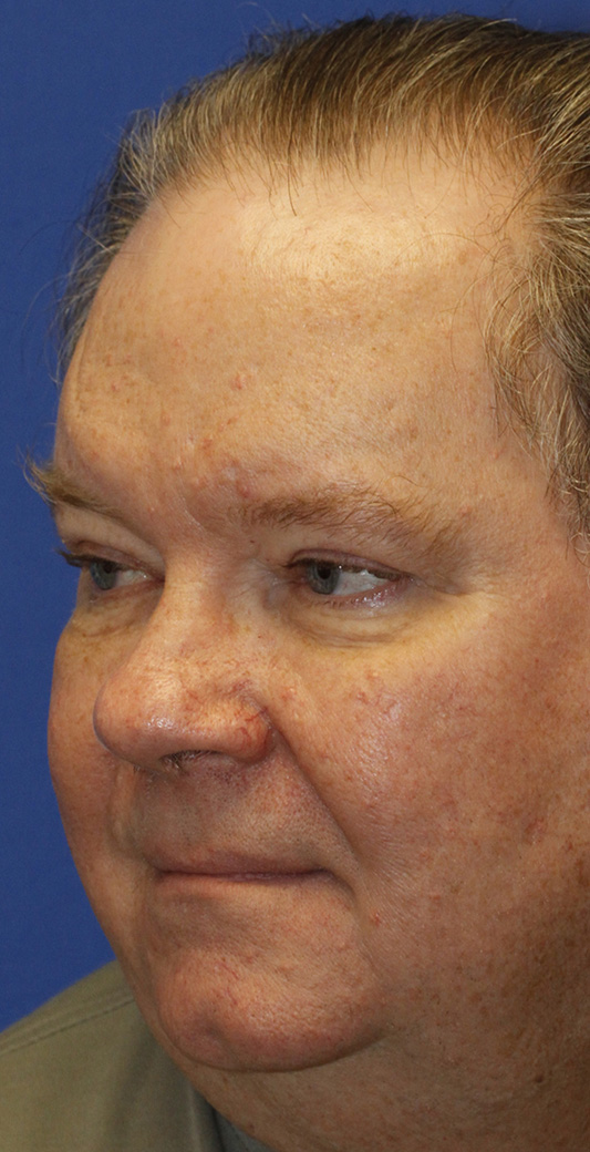 After Male blepharoplasty Photo