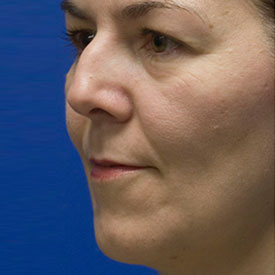 Before Chin Implant Photo