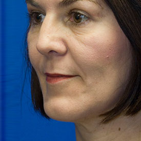 After Chin Implant Photo