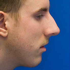 Before Chin Implant Photo