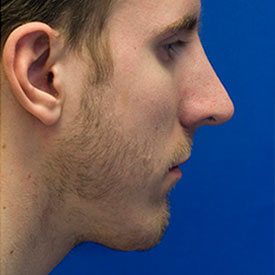 After Chin Implant Photo