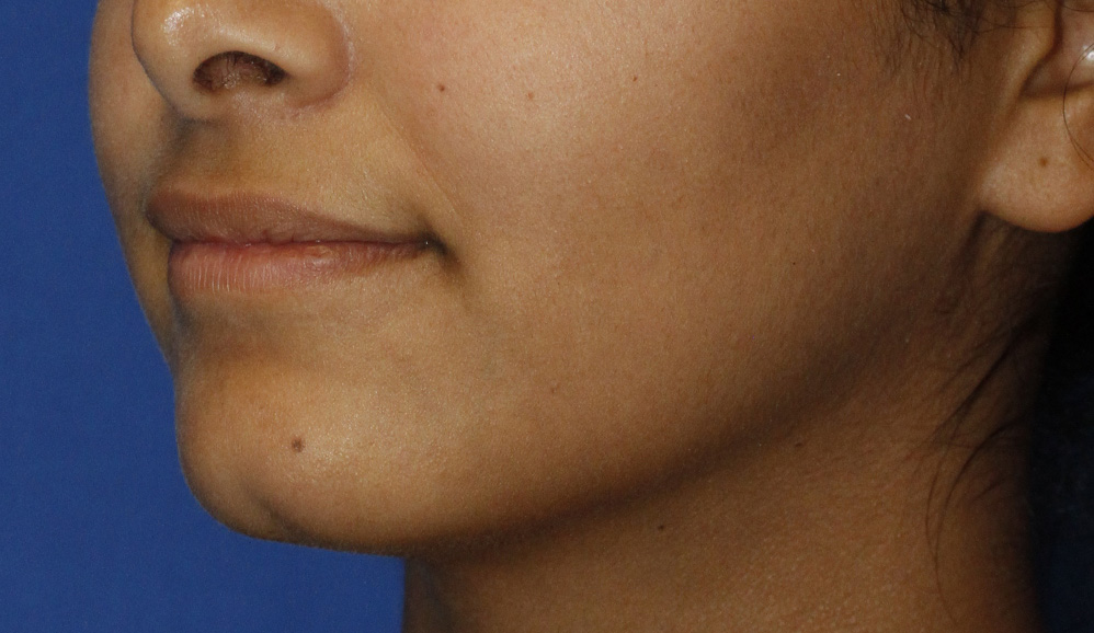 Cleft Chin Before L Oblique