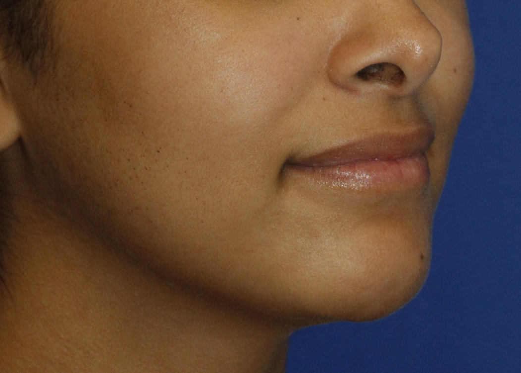 Cleft Chin After R Oblique