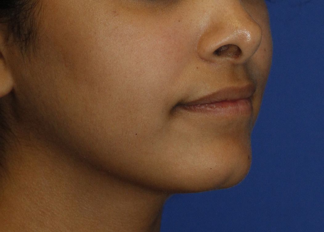 Cleft Chin Before R Oblique
