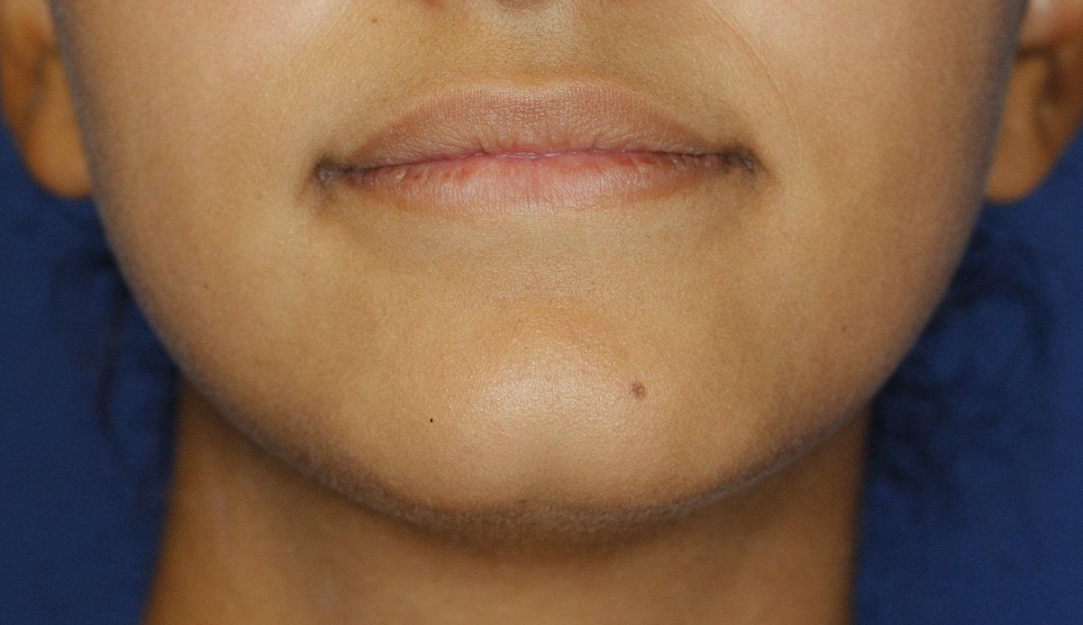 Cleft Chin Before Frontal