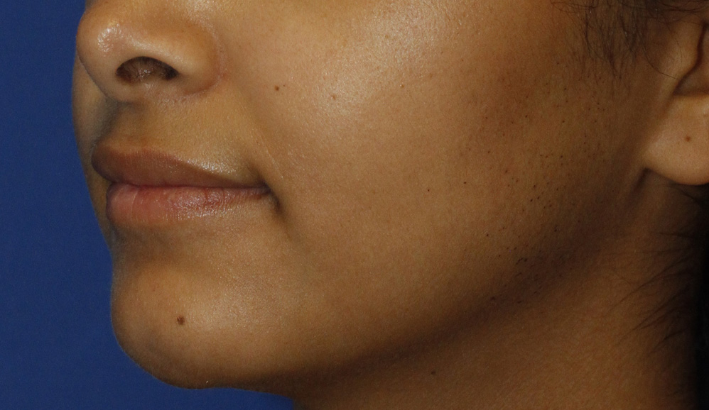 Cleft Chin After L Oblique