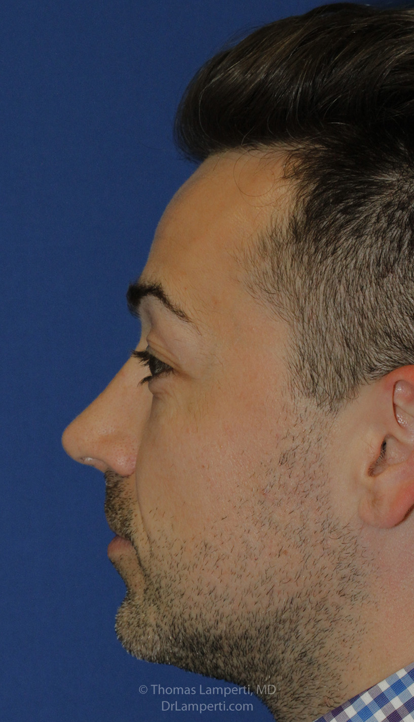 Chin Implant After L Profile